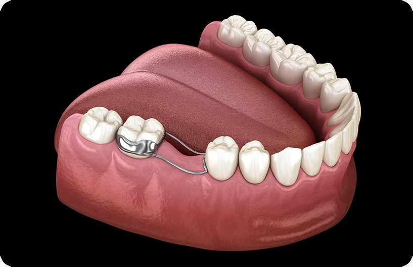 childrens-dentistry-space-maintainers-donsdale-dental-west-edmonton-family-and-general-dentist Children's Dentistry | Donsdale Dental | West Edmonton | Family and General Dentist