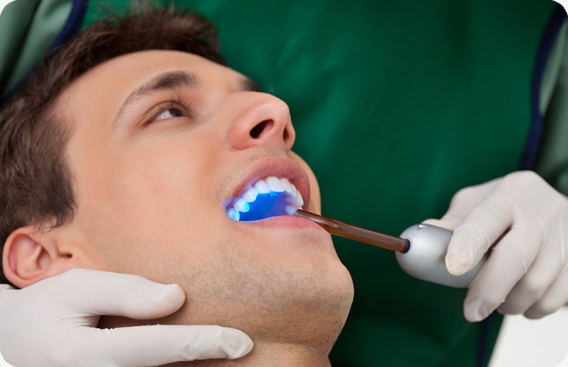 Cosmetic Tooth Bonding | Donsdale Dental | West Edmonton | Family and General Dentist