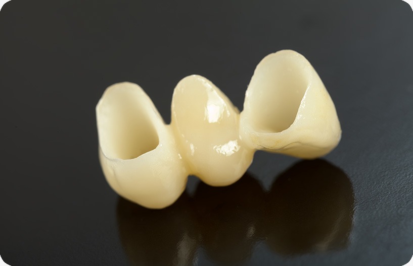 Dental Bridges | Donsdale Dental | West Edmonton | Family and General Dentist