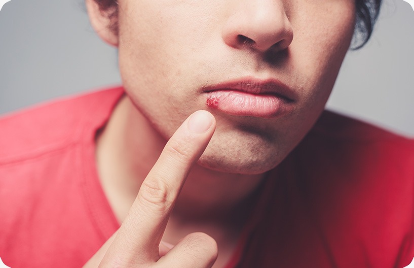 Laser Cold Sore Treatment | Donsdale Dental | West Edmonton | Family and General Dentist