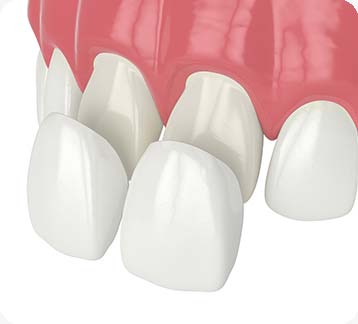 Edmonton Porcelain Veneers | Donsdale Dental | West Edmonton Family Dentist