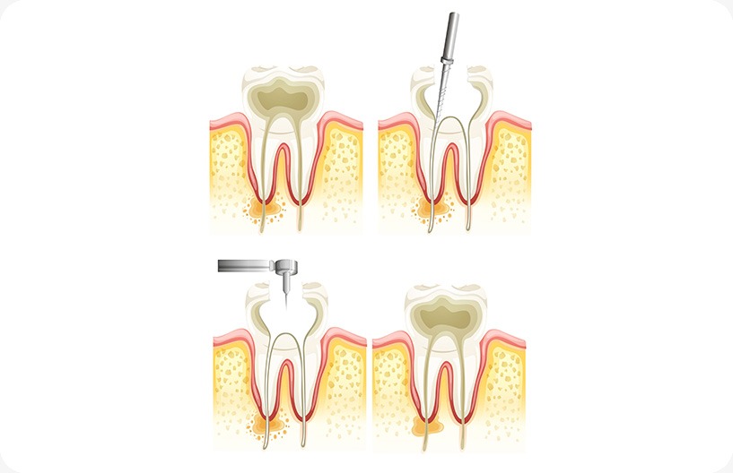 root-canal-process-donsdale-dental-west-edmonton-family-and-general-dentist Edmonton Root Canal Therapy | Donsdale Dental | West Edmonton | Family and General Dentist