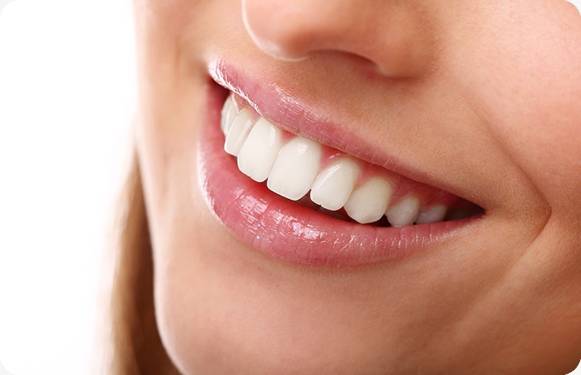 Teeth Whitening | Donsdale Dental | West Edmonton | Family and General Dentist