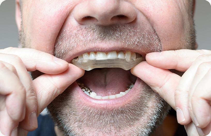 tmj-tmd-therapy-applicance-donsdale-dental-west-edmonton-family-and-general-dentist TMJ/TMD Therapy | Donsdale Dental | West Edmonton | Family and General Dentist