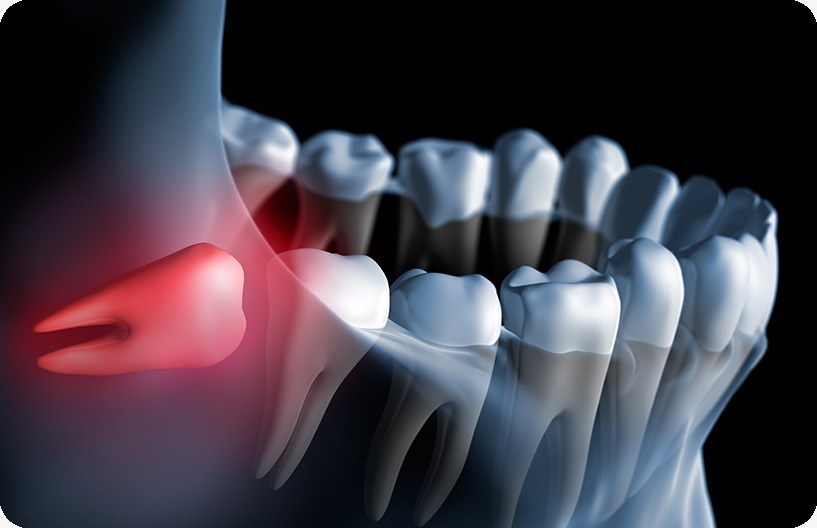 Wisdom Teeth Extraction | Donsdale Dental | West Edmonton | Family and General Dentist