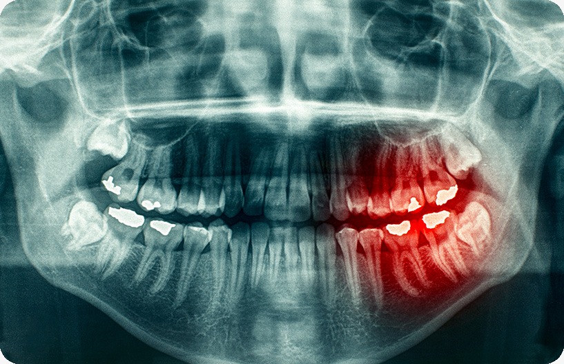 Wisdom Teeth Extraction | Donsdale Dental | West Edmonton | Family and General Dentist