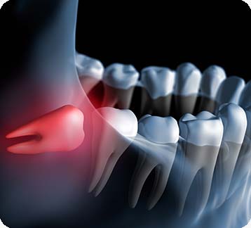 Edmonton Wisdom Teeth Extractions | Donsdale Dental | West Edmonton | Family and General Dentist